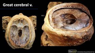 Cranial Cavity and Brain - Veins