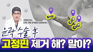 윤곽수술 후 고정핀 제거는 필수일까? 고정핀의 모든 것! #안면윤곽 #광대축소