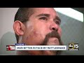 Coolidge man bitten in face by rattlesnake