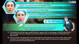 【Course Trailer】Upper Blepharoplasty for sunken eyelid orbital septum thickening release \u0026/or fat