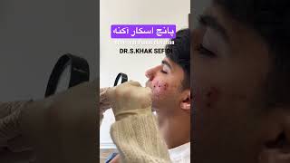 پانچ اسکار آکنه  Elevation Acne ScarPunch #درمان_جای_جوش #پانچ #پانچ_اسکارآکنه