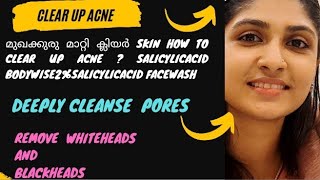 മുഖക്കുരു മാറ്റി ക്ലിയർ skin how to clear up acne ? salicylicacid   bodywise2%salicylicacid facewash