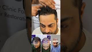 ₹10/- per grafts - 0% EMI - Best Hair Transplant Clinic #hairtransplantclinic  #besthairtransplant