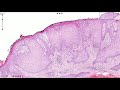 Clear Cell Acanthoma - Skin, Histopathology