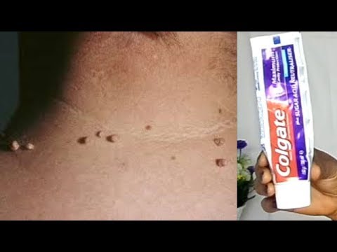 REMOVE SKIN TAG IN 1 NIGHT OF APPLYING TOOTHPASTE REMOVE SKIN TAG IN 1 NIGHT OF APPLYING TOOTHPASTE