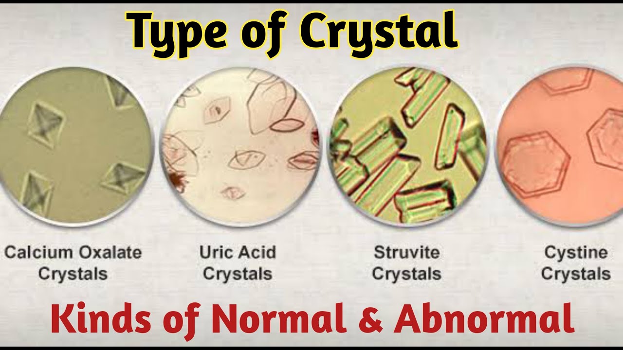 Types Of Crystals In Urine - YouTube