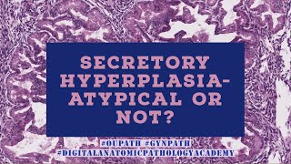 Secretory Hyperplasia- Atypical or Not?