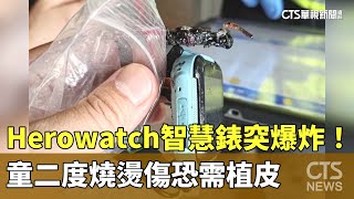 Herowatch智慧錶突爆炸！　童二度燒燙傷恐需植皮｜華視新聞 20230704