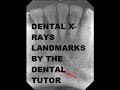 🦷☢ Landmarks for Taking Dental X-Rays and Mounting #dentalradiologist #dentalstudents