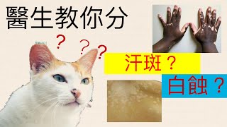 [汗斑]醫生教你在家用洗頭水醫汗斑