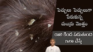 Solution for Dandruff | Get Rid of Dandruff | Thick Hair | Dr. Manthena's Health Tips