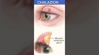 Chalazion(आंखों की पलकों का सूजन)क्यों होता है?#shorts  #shortvideo #shortsfeed #chalazion