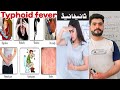 Typhoid fever it's sign & symptoms, causes, risk factors, complications, Diagnosis and treatment