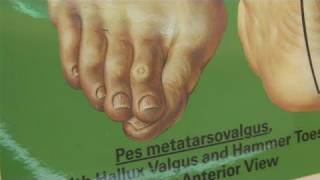 How To Treat Overlapping Toes