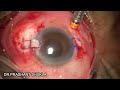 cmt flex hydrophillic lens implantation in aphakia