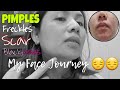 My Face Journey How to Get Rid Pimples | C Coffeemate