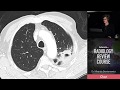 Cavitating Pneumonia - Radiology Review Course