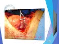 thoracotomy for a long standing bronchial foreign body