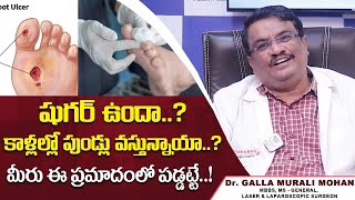 షుగర్ ఉన్నవాళ్లకు కాళ్లలో పుండ్లు || Treatment For Diabetic Foot Ulcer | HyderabadLaserPiles Surgery