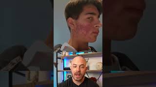 Derm reacts to insane acne transformation! #acne #acnetransformation