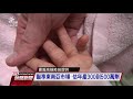 高端腸病毒71型疫苗臨床試驗保護力超過97% 拚明年上市｜20210411 公視晚間新聞