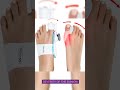 Choosing the right Bunion Corrector  #bunionpainrelief #healthandfitnessmotivation #youtubeshorts