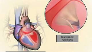 6 Wie kranke Herzklappen eine Herzinsuffizienz hervorrufen können