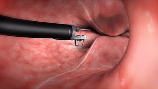 What Happens During the Endoscopic Sleeve Gastroplasty (ESG) Procedure?