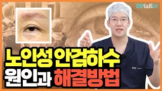 노인성 안검하수 원인과 해결방법