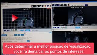 #TUTORIAL | CÁLCULO DO VOLUME DA OROFARINGE - SOFTWARE DOLPHIN IMAGING 11.95