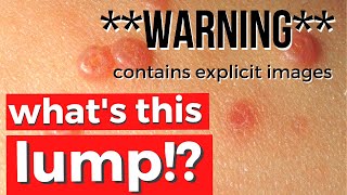 Do you have GENITAL WARTS or other LUMPS?