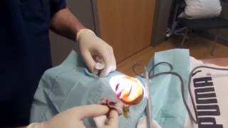 Lingual Frenectomy- Dr. Mountcastle performing a lingual frenectomy