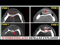 Chondromalacia patellae - The 4 stages and their treatment explained