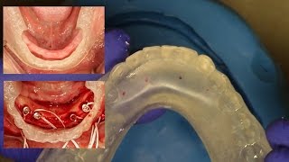 Easy Clinical & Laboratory Technique for Fabricating an 