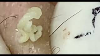 Blackheads Removal | Acne Treatment and Very Satisfying Satisfying Pimple pop #blackheads