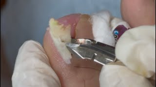 Ep_7481 Big ingrown toenail removal 👣ใช้เวลาข้างละไม่ถึง 2 นาที..ไม่ต้องกลัวนะ 😄(clip from Thailand)