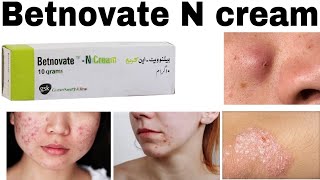 Betnovate n Skin care Cream: How to use, Benefits \u0026 Side effects