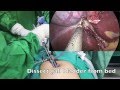 Single Incision Laparoscopic Cholecystectomy