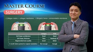 [Master Course - SURGERY] Socket preservation