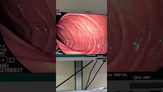 منظار معدة مع أخذ عينة من المعدة Upper endoscopy ( OGD ) with biopsy