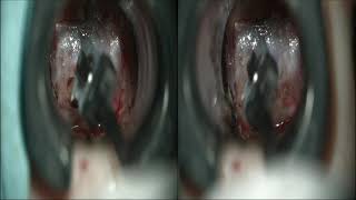 Rathke's Cleft Cyst Resection