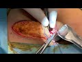 diamond shaped flap anoplasty for severe anal stenosis a video vignette