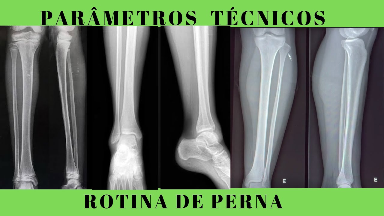 Rotina De Perna- Como Fazer Uma Radiografia Padrão - YouTube