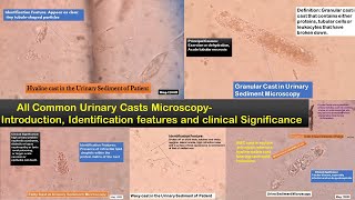 All Common Urine Casts Microscopy: Introduction, Identification hints and Clinical significance