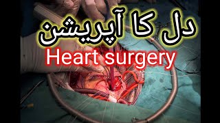 دل کا آپریشن // heart surgery // heart oppression by fahim