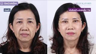 รีวิวดึงหน้าหลังทำไม่ถึง 24 ชม สามารถใช้ชีวิตได้ปกติ 👩