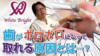 【仙台】歯がボロボロになって取れる原因とは...？｜ホワイトブライトデンタルオフィス