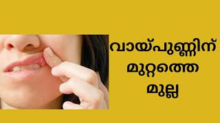 വായ്പുണ്ണ്  ഒരു ദിവസം കൊണ്ട് മാറ്റാൻ/  Mouth Ulcer  Home remedy