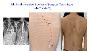 MIS Scoliosis Surgical Technique