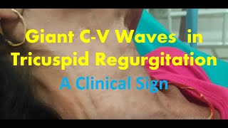 Giant C-V Waves of Tricuspid Regurgitation | JVP | Clinical Sign | Cardiology